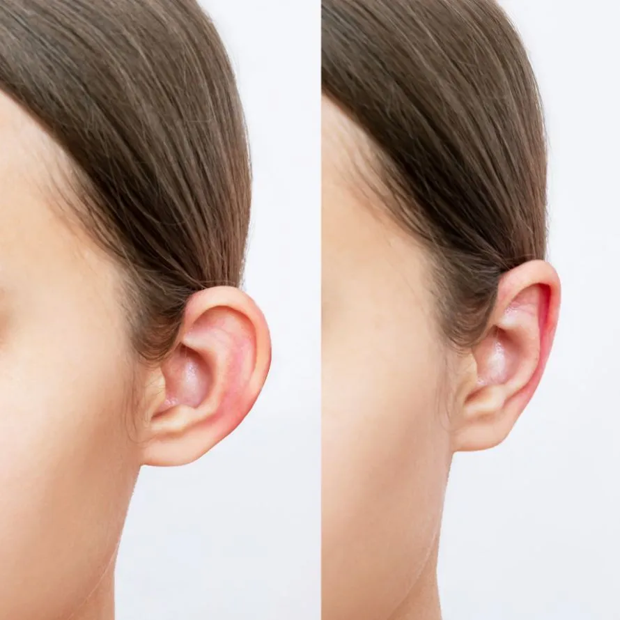 Comparação entre uma orelha proeminente antes e depois da cirurgia