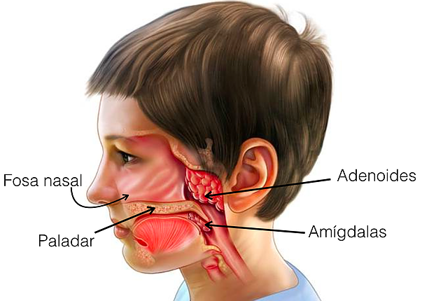 Hipertrofia das Amígdalas e Adenoides