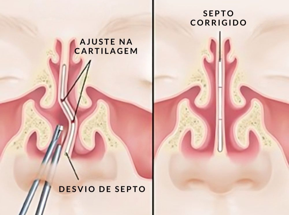 Desvio de Septo