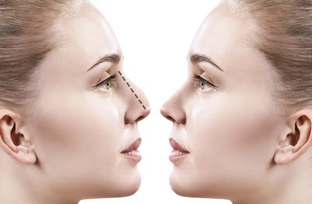 Rinoplastia